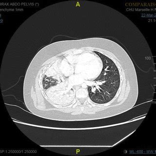 Admission CT-scan showing complete obstructive atelectasis of the right... | Download Scientific ...