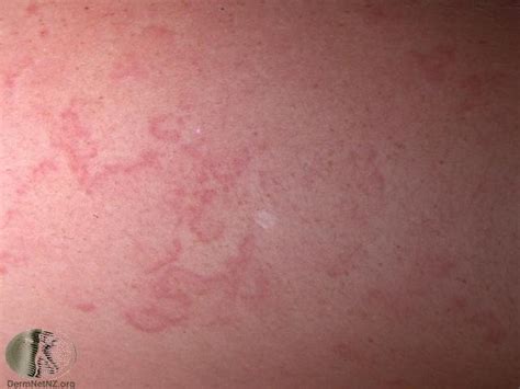 Erythema Marginatum Pictures Causes Signs And Symptoms Treatment