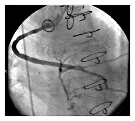 (a) Right coronary artery 100% occluded in the proximal segment. (b ...