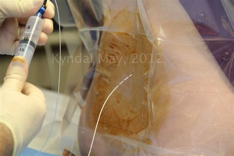 Epidural Procedure - Baby Bump Services