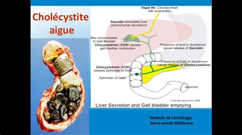 Cholécystite aiguë Cours de Hepato gastro enterologie YouTube