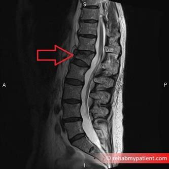 Spinal Cord Injuries Disease Flashcards Quizlet