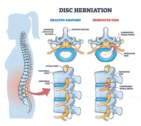 Disc Herniation Or Spine Nerve Compression Vs Healthy Anatomy Outline