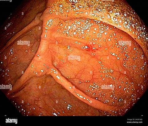 Angiodysplasia Endoscopic View Of The Interior Of A Patient S Caecum