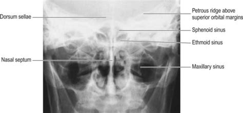 Paranasal Sinuses X Ray