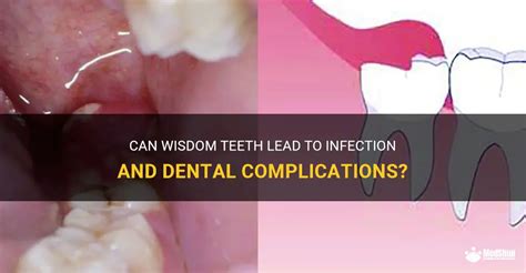 Can Wisdom Teeth Lead To Infection And Dental Complications? | MedShun