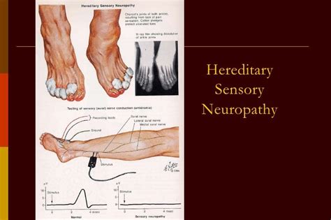 Sensorimotor Polyneuropathy Pictures