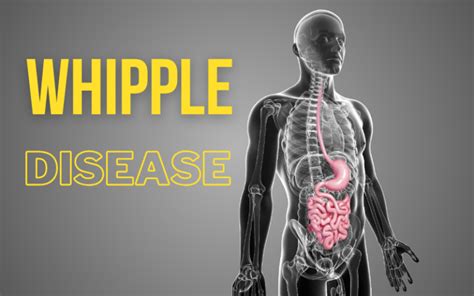 Whipple Warnings: The 10 Tell-Tale Symptoms of the Disease