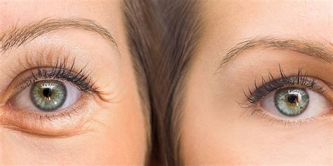 Under Eye Hollows Correction Richmon Hill Clinic