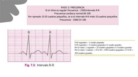 Caso Clinico De Electrocardiograma Basado Realmente Ppt Descarga