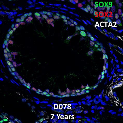 Years Old Human Lung With Asthma Immunofluorescence And Confocal