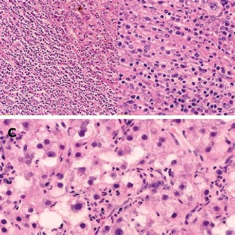 Growth patterns of progressed hepatocellular carcinoma. A ...