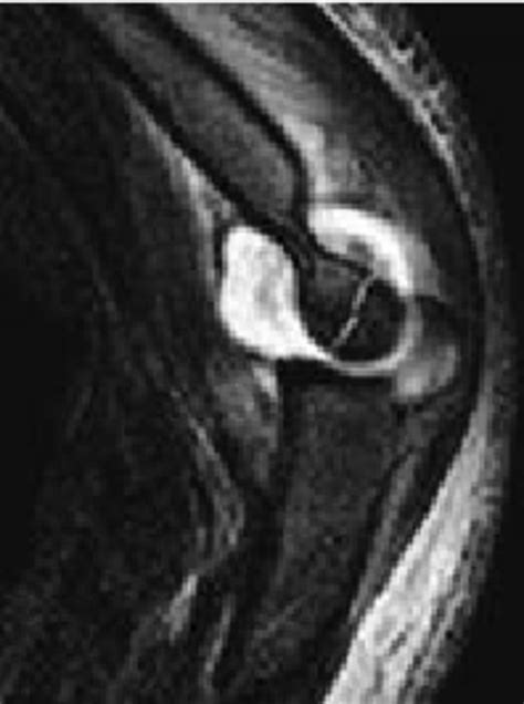 Case two. MRI confirms the diagnosis of humeral lateral condyle ...