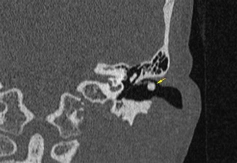 Pixel External auditory canal Osteoma