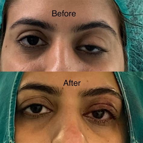 Ptosis Correction Sheraz Plastic Surgery