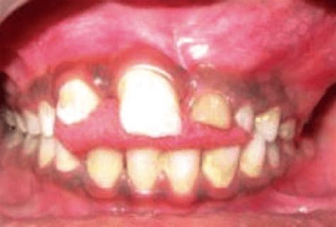 Yellowish Discoloration Primary Tooth Download Scientific Diagram