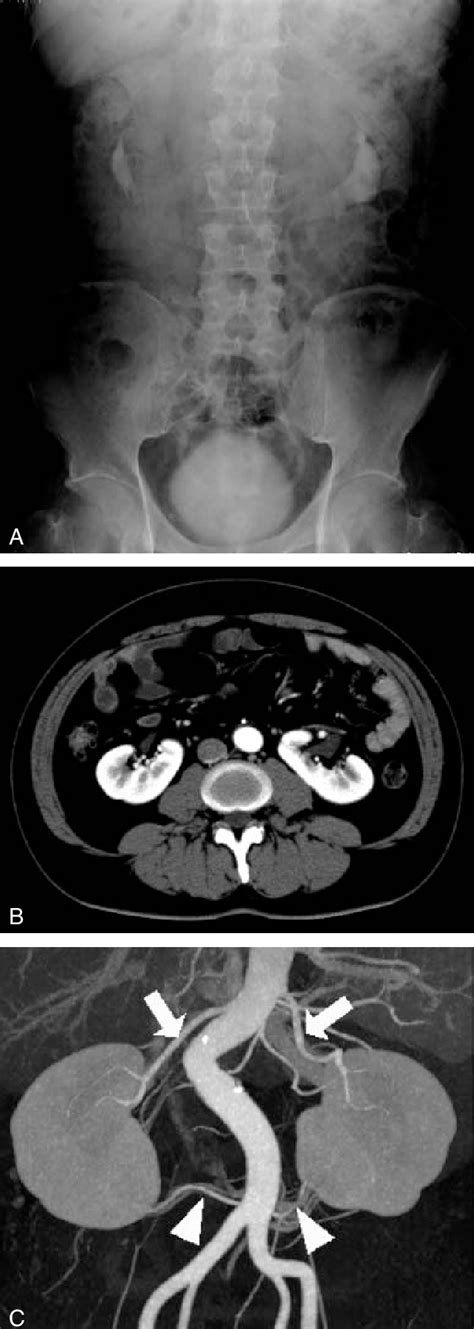 Figure From An Unusual Renal Vascular Anomaly Common Origin Of