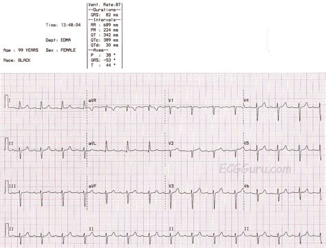 Left Anterior Fascicular Block | ECG Guru - Instructor Resources