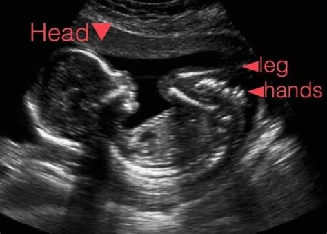 ultrasound near me pregnancy - Marlo Teel