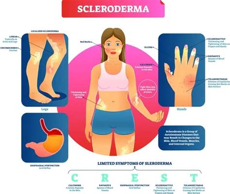 Scleroderma Specialist Brisbane Au