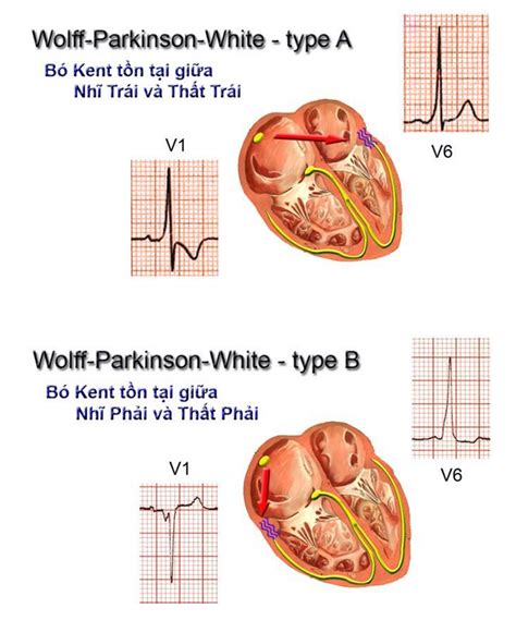 Hội Chứng Wolff Parkinson White Wpw Là Gì Dấu Hiệu Nhận Biết