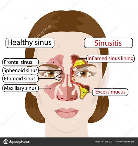 How To Drain Frontal Sinuses Tranet Biologia Ufrj Br