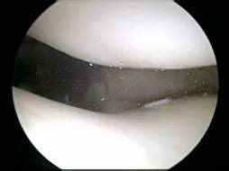 Keyhole surgery - Knee Arthroscopy - City Hospital, Dehradun