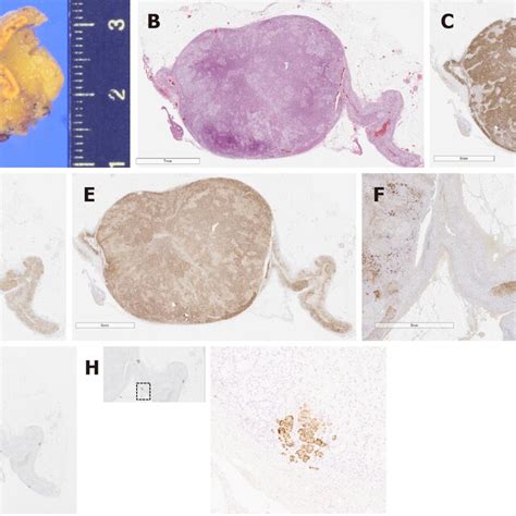 Pathological Findings Regarding The Adrenocortical Adenoma And Attached Download Scientific