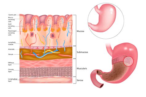 What Is Stomach Cancer Roswell Park Comprehensive Cancer Center