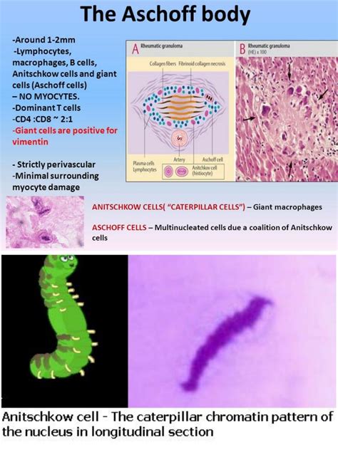 Antiscchkow cell and Aschoff cell ... #Macrophage | Collagen fibers, Cell, Pathology