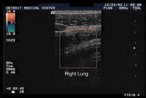 Lung Ultrasound And The Blue Protocol Crashing Patient