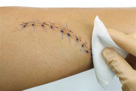 Royalty Free Stitches And Scars Pictures, Images and Stock Photos - iStock