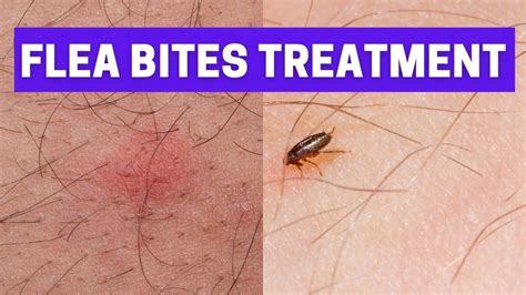 How To Treat Flea Bites At Home Ways To Get Rid Of Flea Bites Youtube