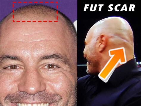 Joe Rogan Hair Transplant Failure! Here's what went wrong!