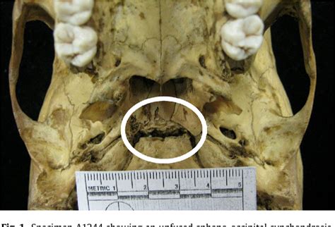 Spheno Occipital Suture