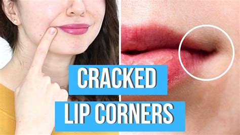 How To Heal Dry Cracked Lip Corners At Joshua Fulton Blog