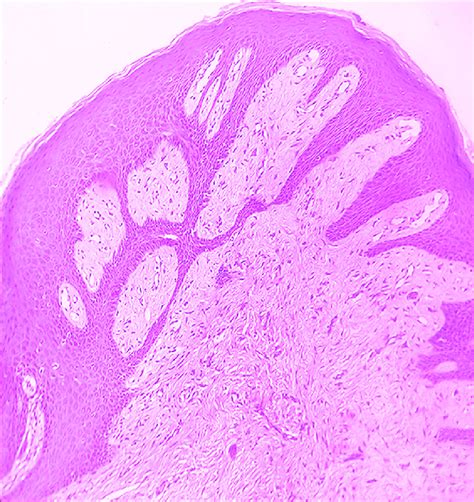 Moderately Acanthotic Epidermis Fibromyxoid Stroma With Dilated Blood