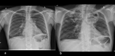 A Chest X Ray Demonstrating Calcification In The Hilum 2 B Large Bi Download Scientific