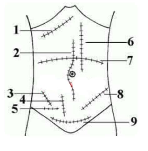 Abdominal Incisions Diagram Quizlet