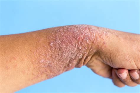 IStock 825903086 Hand Dermatitis