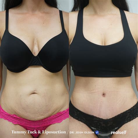 How To Care For Belly Button After Tummy Tuck Larita Krichbaum