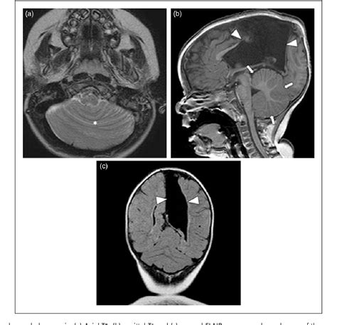 Figure 4 From Congenital Basis Of Posterior Fossa Anomalies Semantic