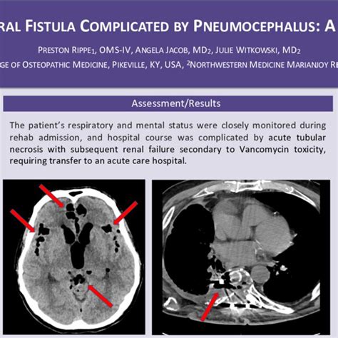 Initial Ct Imagine Of The Head Demonstrating Pneumocephalus Figure