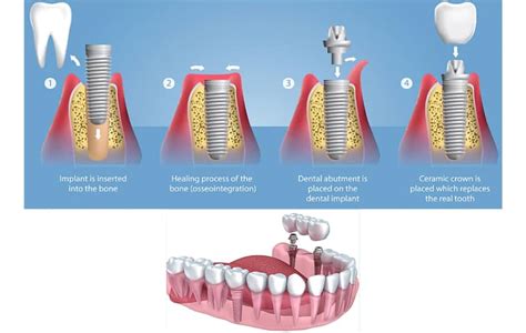 Best Wisdom Tooth Removal Treatment in Mumbai- ToothFix