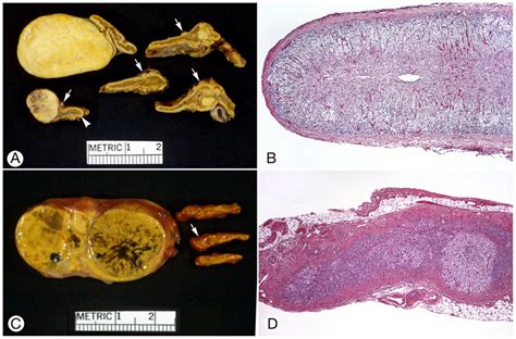 Adrenocortical Adenomas And Extra Tumoral Cortex A And B Patient 5 C Download Scientific