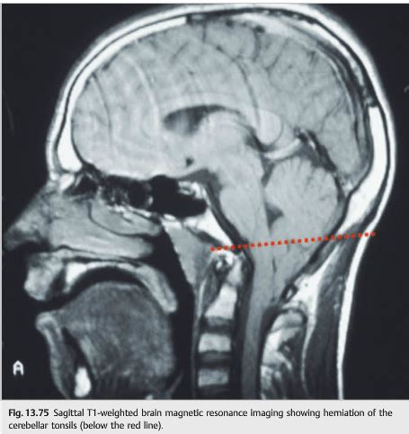 Neuro-ophthalmology Illustrated Chapter 13 – 4 – 6th Nerve Palsy ...