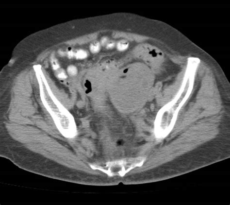 Diverticulitis Abscess