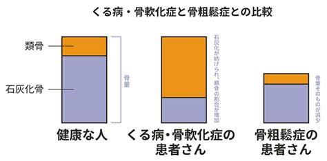 くる病・骨軟化症とは くるこつ広場