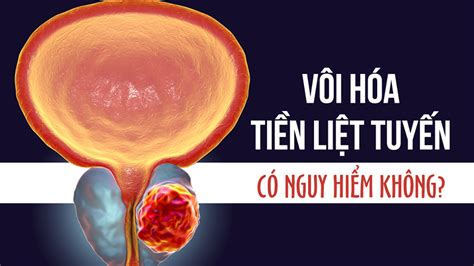 Các thông tin vôi hoá tiền liệt tuyến là gì cần biết