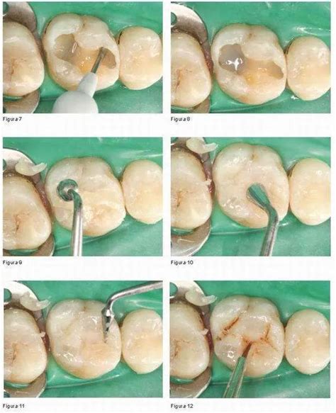 Cómo se hace un empaste dental Dentisalut